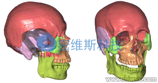 头骨修复